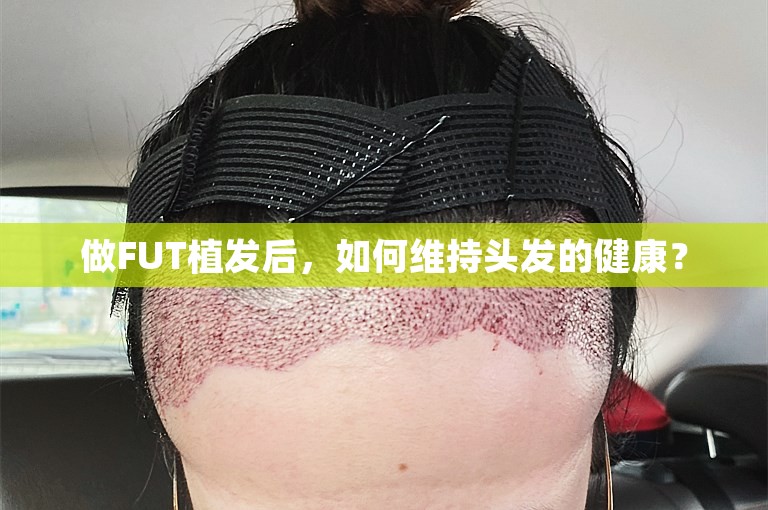 做FUT植发后，如何维持头发的健康？