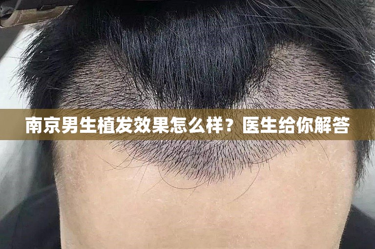 南京男生植发效果怎么样？医生给你解答