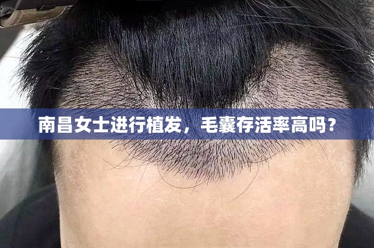 南昌女士进行植发，毛囊存活率高吗？