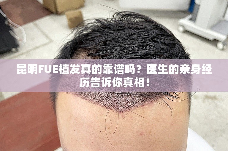 昆明FUE植发真的靠谱吗？医生的亲身经历告诉你真相！