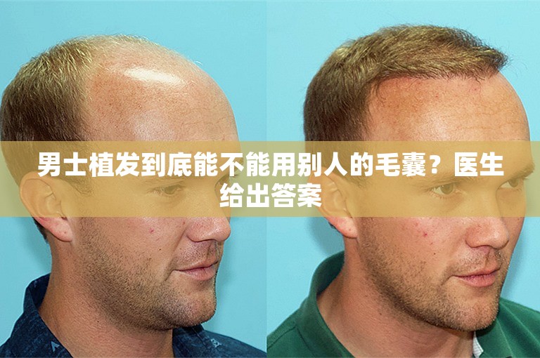 男士植发到底能不能用别人的毛囊？医生给出答案