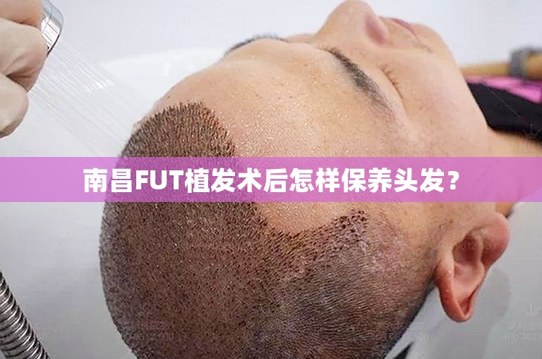 南昌FUT植发术后怎样保养头发？