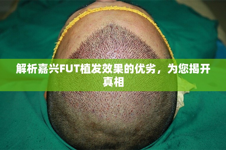 解析嘉兴FUT植发效果的优劣，为您揭开真相