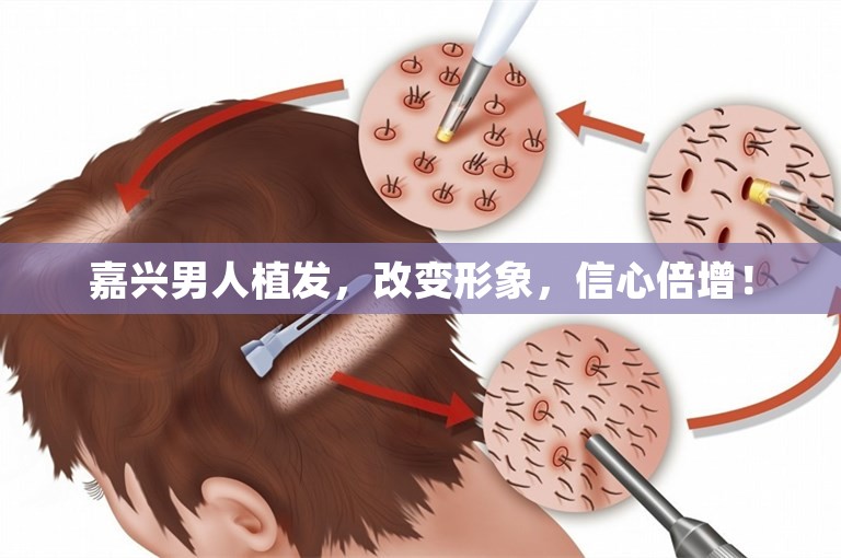 嘉兴男人植发，改变形象，信心倍增！