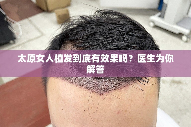 太原女人植发到底有效果吗？医生为你解答