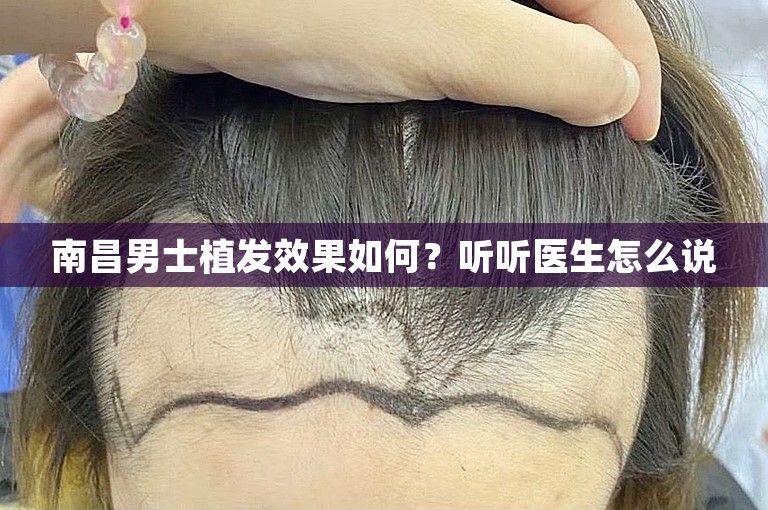 南昌男士植发效果如何？听听医生怎么说