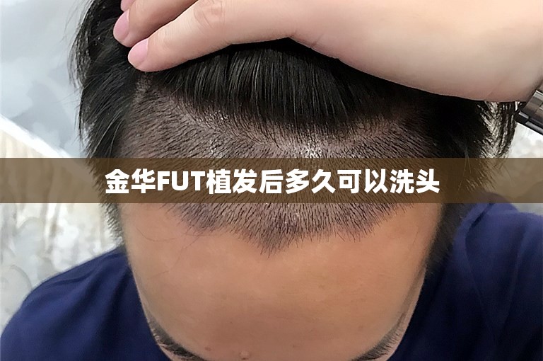 金华FUT植发后多久可以洗头