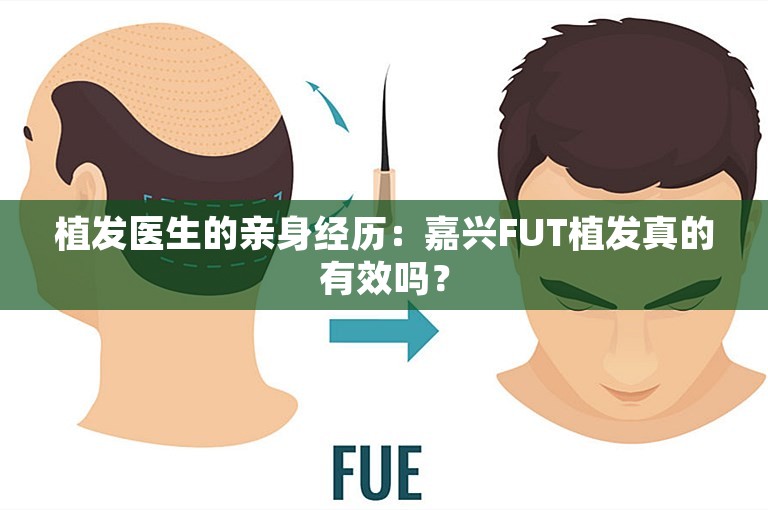 植发医生的亲身经历：嘉兴FUT植发真的有效吗？