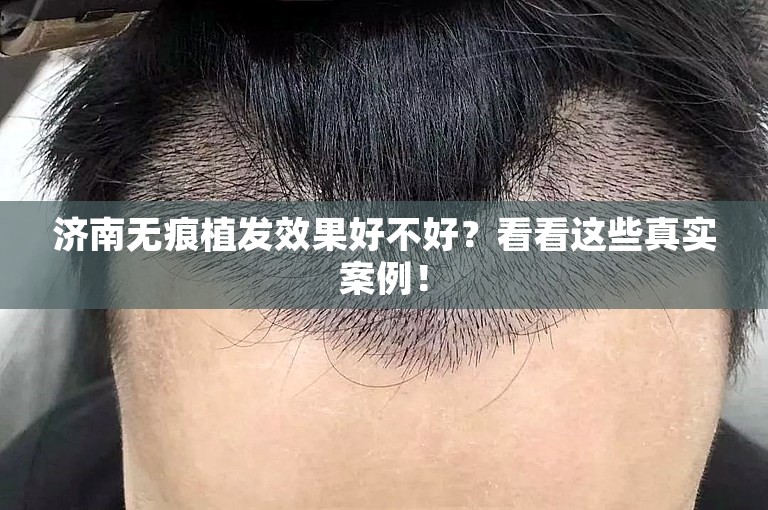 济南无痕植发效果好不好？看看这些真实案例！