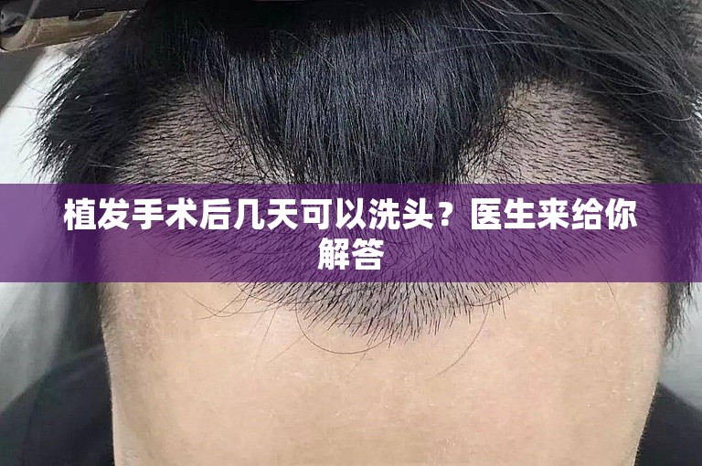 植发手术后几天可以洗头？医生来给你解答