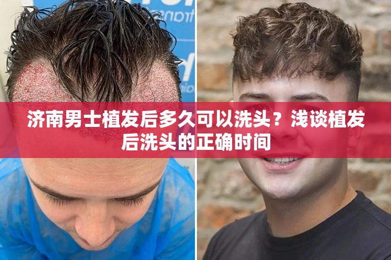 济南男士植发后多久可以洗头？浅谈植发后洗头的正确时间