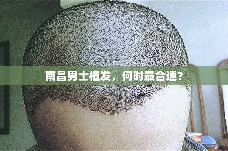 南昌男士植发，何时最合适？