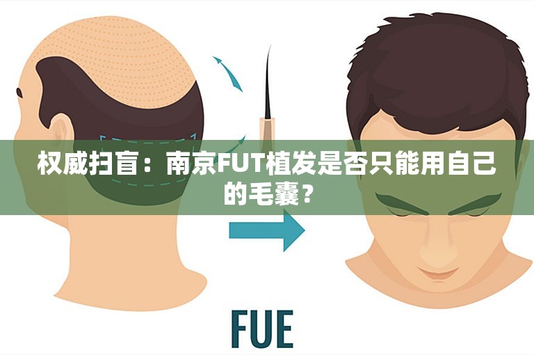 权威扫盲：南京FUT植发是否只能用自己的毛囊？