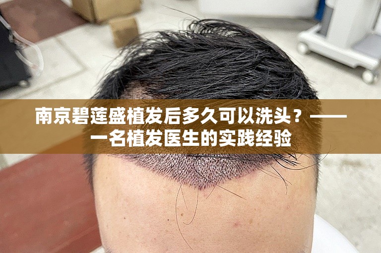 南京碧莲盛植发后多久可以洗头？——一名植发医生的实践经验