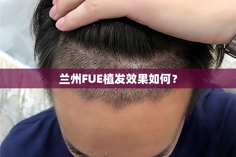 兰州FUE植发效果如何？