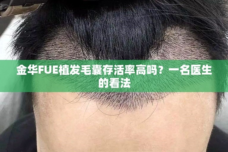 金华FUE植发毛囊存活率高吗？一名医生的看法