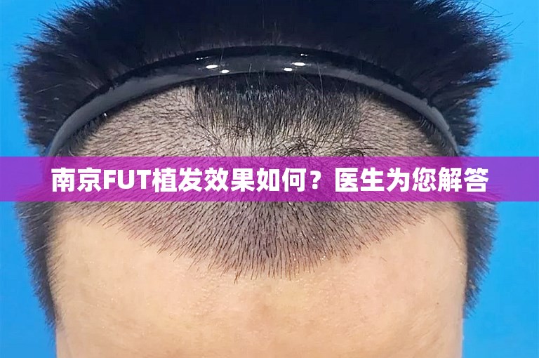 南京FUT植发效果如何？医生为您解答