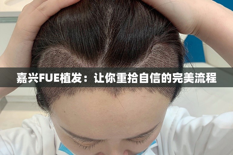 嘉兴FUE植发：让你重拾自信的完美流程