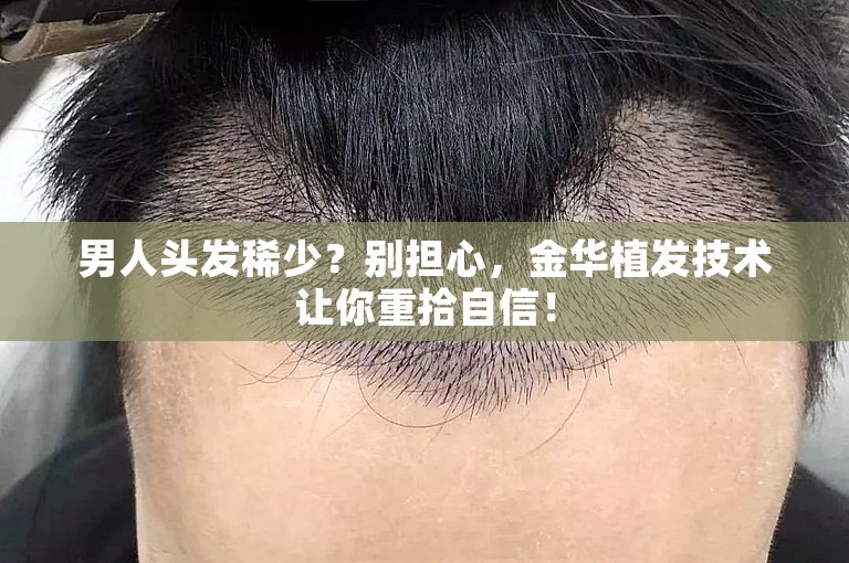 男人头发稀少？别担心，金华植发技术让你重拾自信！