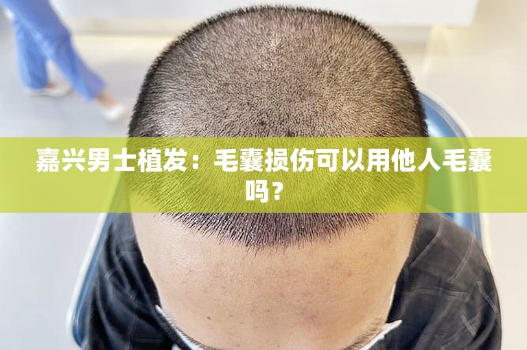 嘉兴男士植发：毛囊损伤可以用他人毛囊吗？