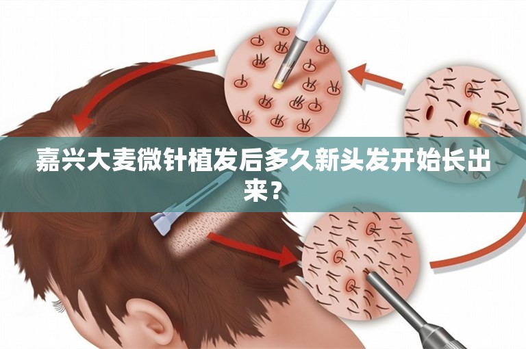 嘉兴大麦微针植发后多久新头发开始长出来？