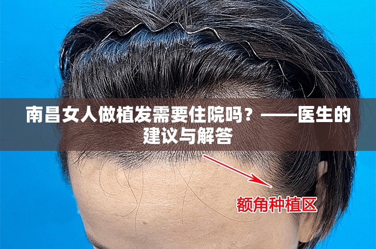 南昌女人做植发需要住院吗？——医生的建议与解答