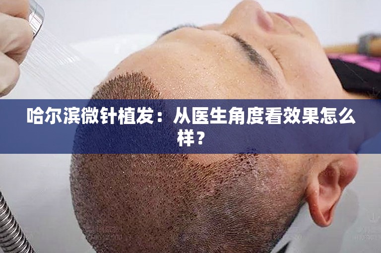 哈尔滨微针植发：从医生角度看效果怎么样？