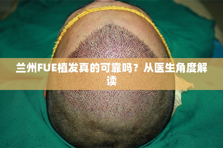 兰州FUE植发真的可靠吗？从医生角度解读