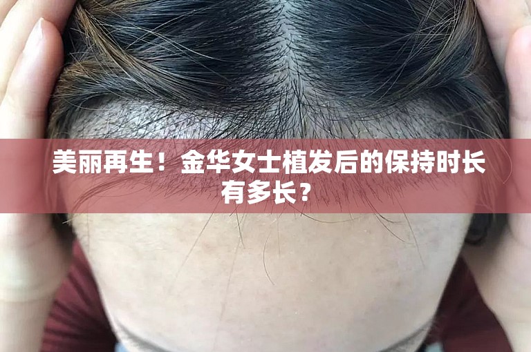  美丽再生！金华女士植发后的保持时长有多长？