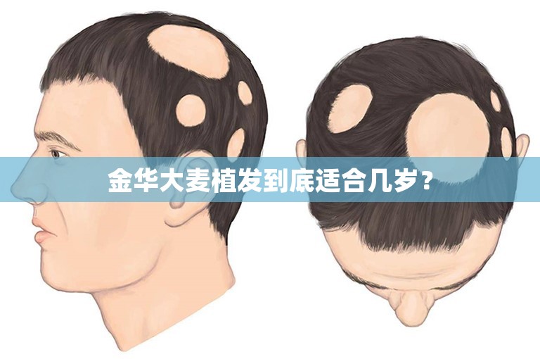 金华大麦植发到底适合几岁？