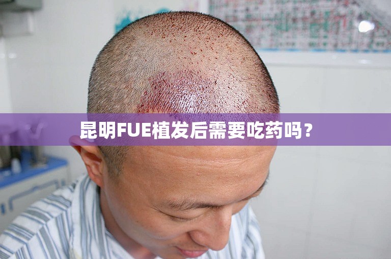 昆明FUE植发后需要吃药吗？