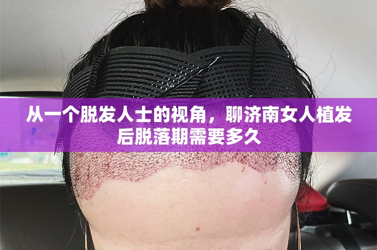 从一个脱发人士的视角，聊济南女人植发后脱落期需要多久