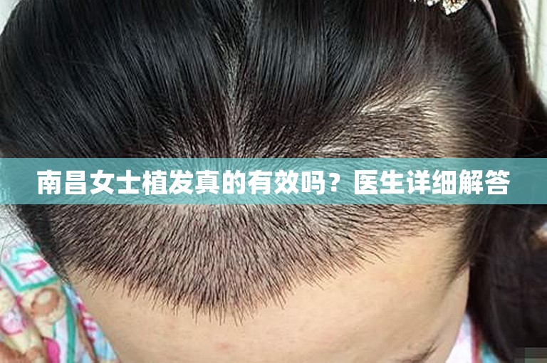 南昌女士植发真的有效吗？医生详细解答