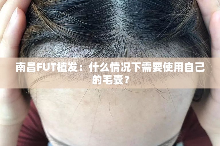 南昌FUT植发：什么情况下需要使用自己的毛囊？