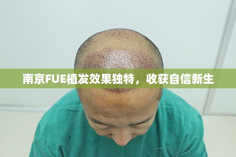 南京FUE植发效果独特，收获自信新生