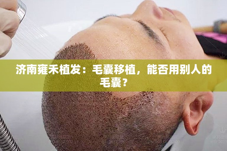 济南雍禾植发：毛囊移植，能否用别人的毛囊？