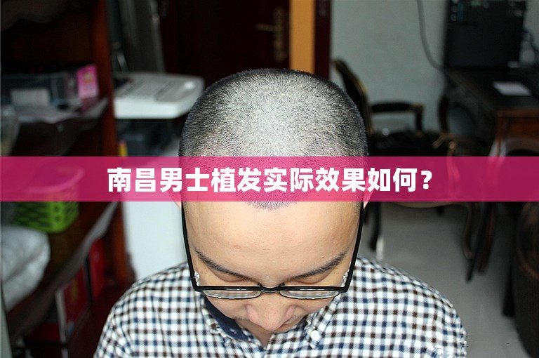 南昌男士植发实际效果如何？