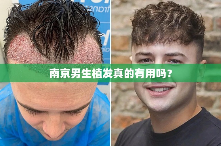 南京男生植发真的有用吗？