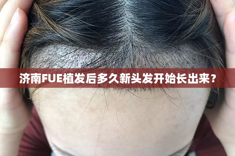 济南FUE植发后多久新头发开始长出来？