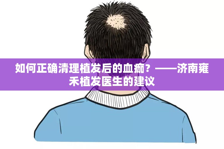 如何正确清理植发后的血痂？——济南雍禾植发医生的建议