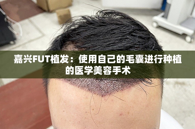 嘉兴FUT植发：使用自己的毛囊进行种植的医学美容手术