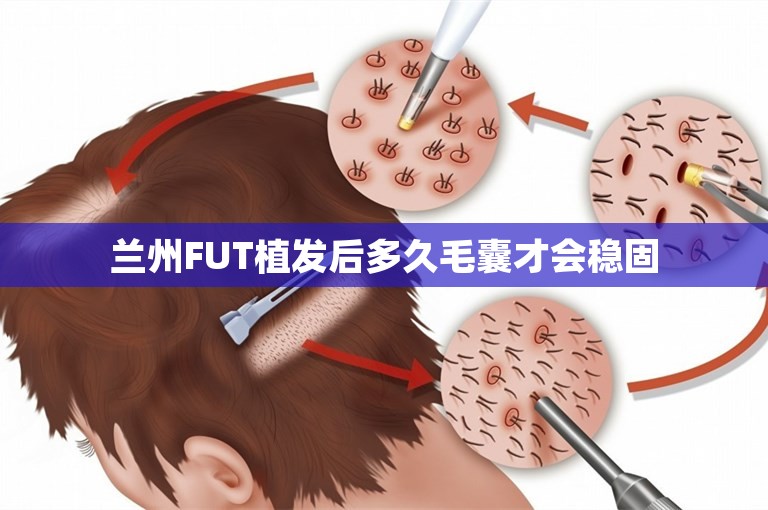 兰州FUT植发后多久毛囊才会稳固