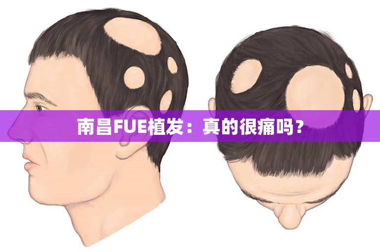 南昌FUE植发：真的很痛吗？