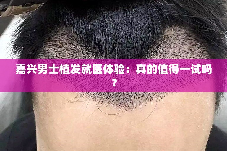 嘉兴男士植发就医体验：真的值得一试吗？