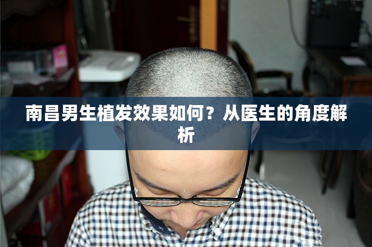 南昌男生植发效果如何？从医生的角度解析