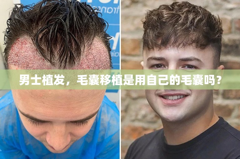 男士植发，毛囊移植是用自己的毛囊吗？