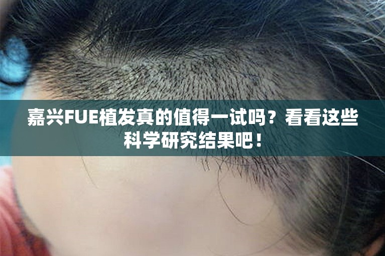 嘉兴FUE植发真的值得一试吗？看看这些科学研究结果吧！