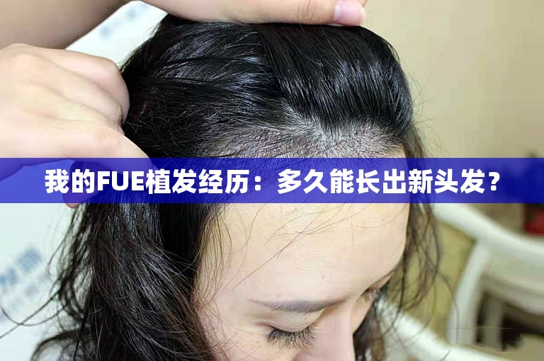 我的FUE植发经历：多久能长出新头发？