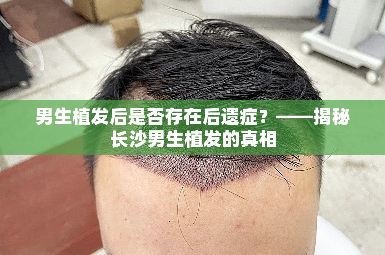 男生植发后是否存在后遗症？——揭秘长沙男生植发的真相