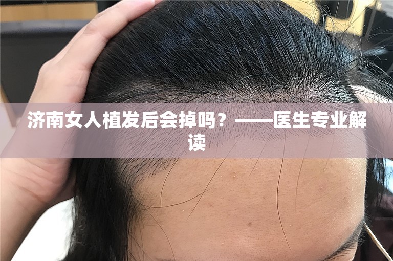 济南女人植发后会掉吗？——医生专业解读